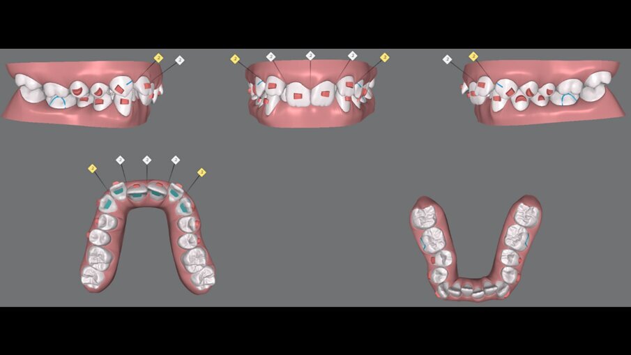 Fig. 12_ClinCheck Virtual Planning di fase 1.