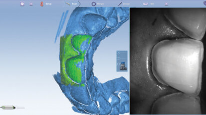 Click here! Digital impression margination made easy
