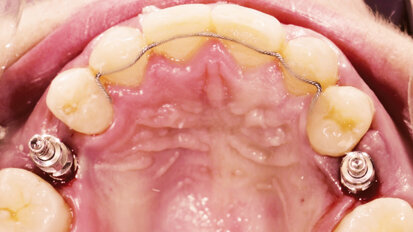 Implantace pomocí dynamické navigace s okamžitým zatížením