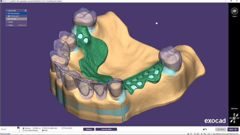 Exocad releases PartialCAD 3.0 GALWAY with advanced design features