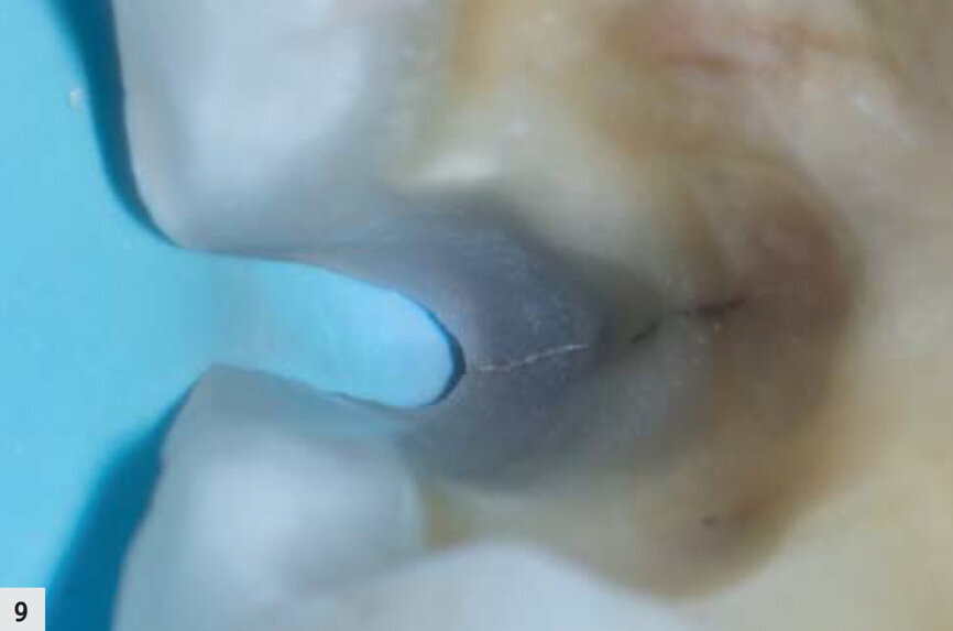 Fig. 9 : La préparation laisse un bord lisse et sain.