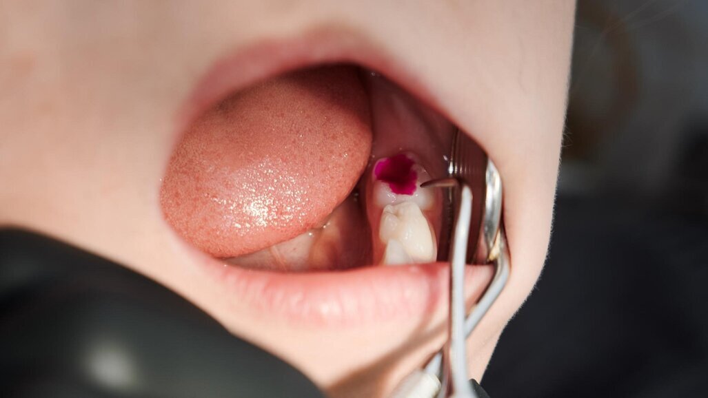 98% dzieci w Polsce cierpi na chorobę próchnicową, a tylko 1% dorosłych posiada zdrowe przyzębie