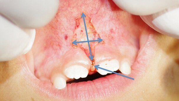 Frénectomie labiale supérieure