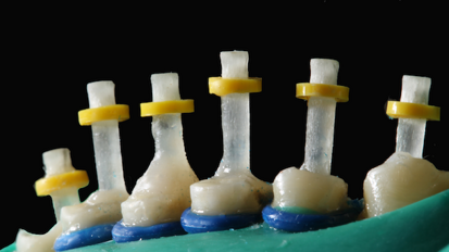 Acondicionamiento del canal radicular para colocar un perno de fibra de vidrio Acondicionamiento del canal radicular para colocar un perno de fibra de vidrio