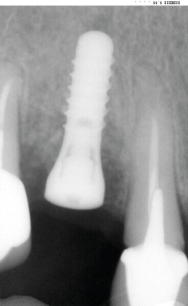 Fig. 9 : Contrôle à quatre mois. 
