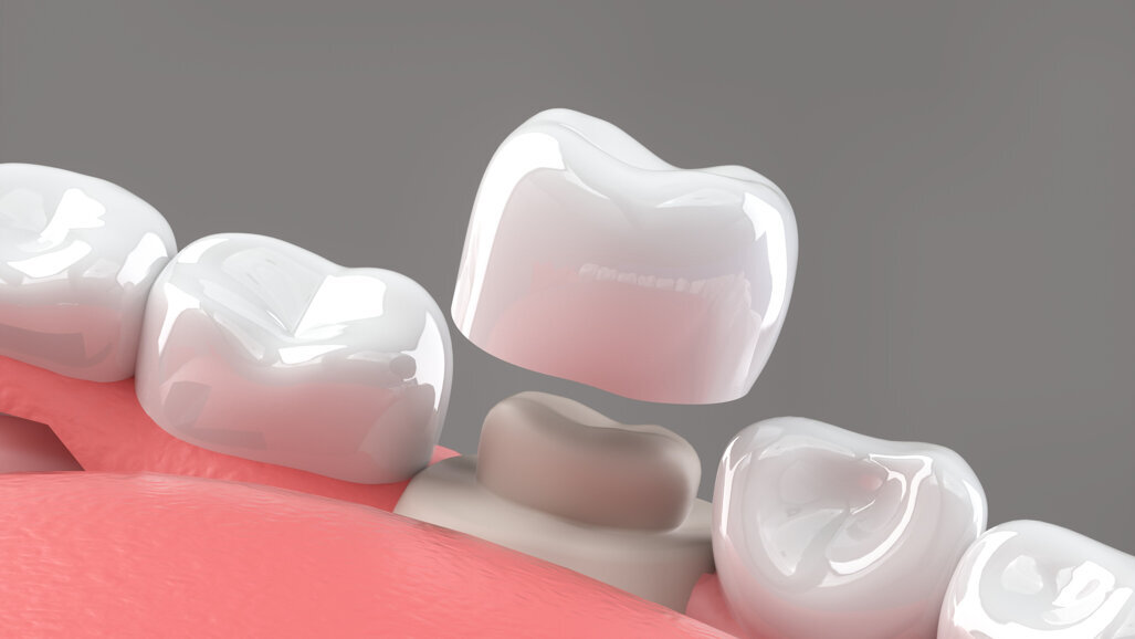 Bredent announces hands on implant workshops