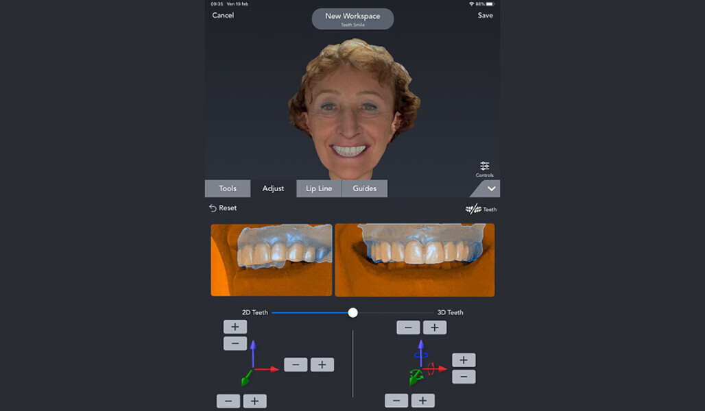 Fig. 8: Smile design for the production of the temporary restoration.