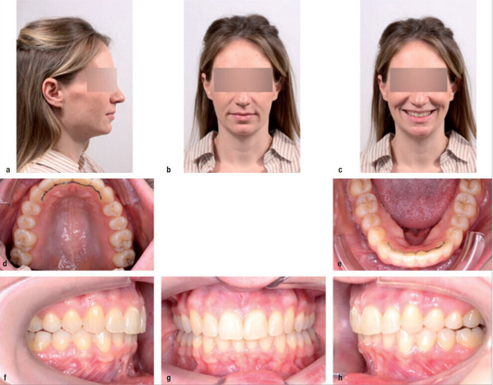 Figs. 8a–h: Patient at the end of treatment after 72 aligners.