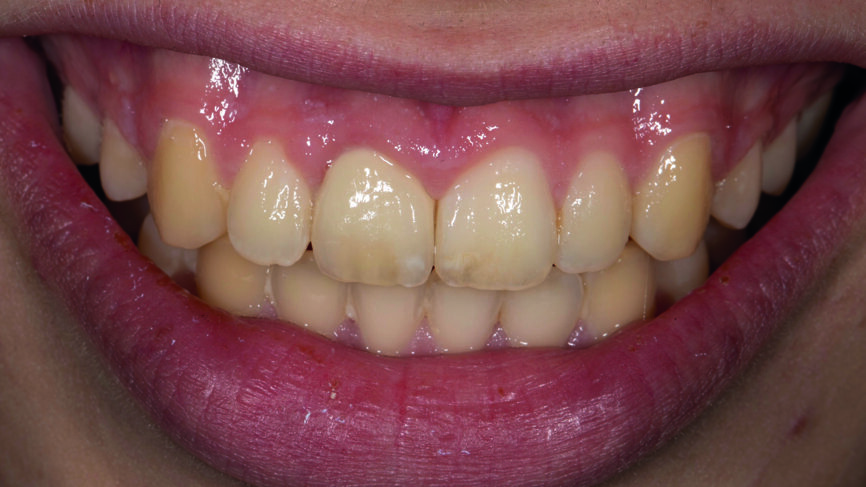 Fig. 12 : Résultat final en bouche.