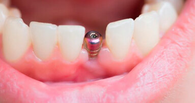 Un nuovo rivestimento potrebbe eliminare il rischio di insuccessi implantari