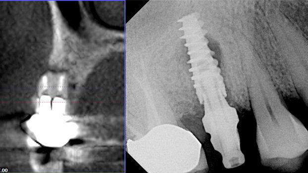 Avoiding the pitfalls of implants with 3-D imaging