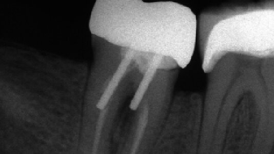 Hlavní zásady, které zvyšují úspěšnost rekonstrukce endodonticky ošetřených zubů