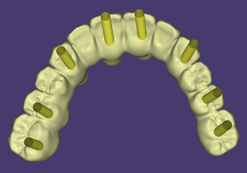 Fig. 5h: Virtual design of the Misch classification FP-1 restoration in exocad.