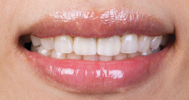 Meeting an anterior esthetic challenge