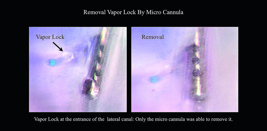 Fig. 1b: Sleiman-Iandolo testing. Demonstrating the airlock eliminated with the use of the negative pressure irrigation system (NB: other means such as further PUI or use of lateral-vented needle were not helpful in overcoming the vapor lock once produced, the gas bubble remained in place).