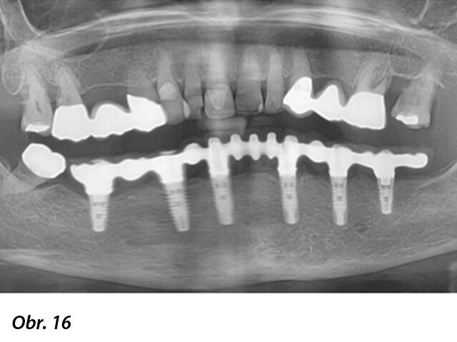 Panoramatický RTG snímek z kontroly po 12 měsících.