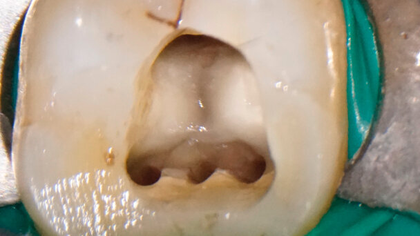 Evoluzione clinica e tecnologica in Endodonzia