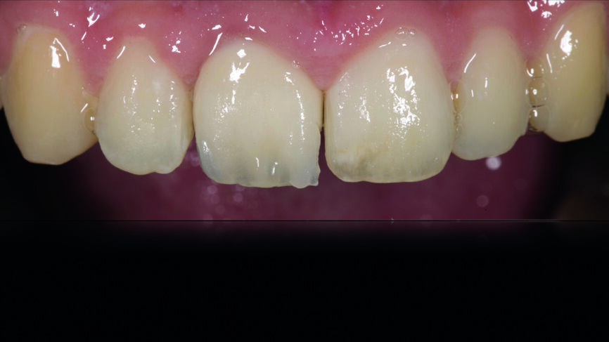 Fig. 10 : Essayage après la première cuisson. 