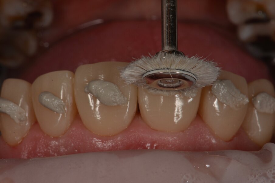 Indien gewenst kan nog worden nagepolijst met een diamantpasta en een geitenhaar borstel.