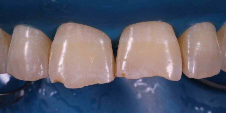 Fig 7. Isolation with Rubber dam