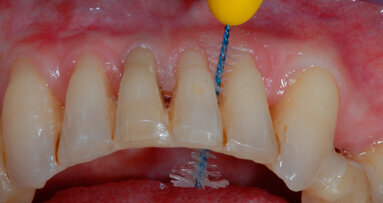 Nuovo spazzolino interdentale con disegno anatomico per la detersione degli spazi interprossimali