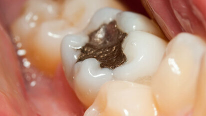 Sul tema “amalgama” aggiornamenti, prospettive ed implicazioni legali