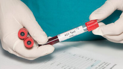 Derivati dei batteri parodontali potrebbero riattivare l’HIV latente