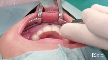 Nobel Biocare - Restoration of a central incisor Nobel Biocare - Restoration of a central incisor