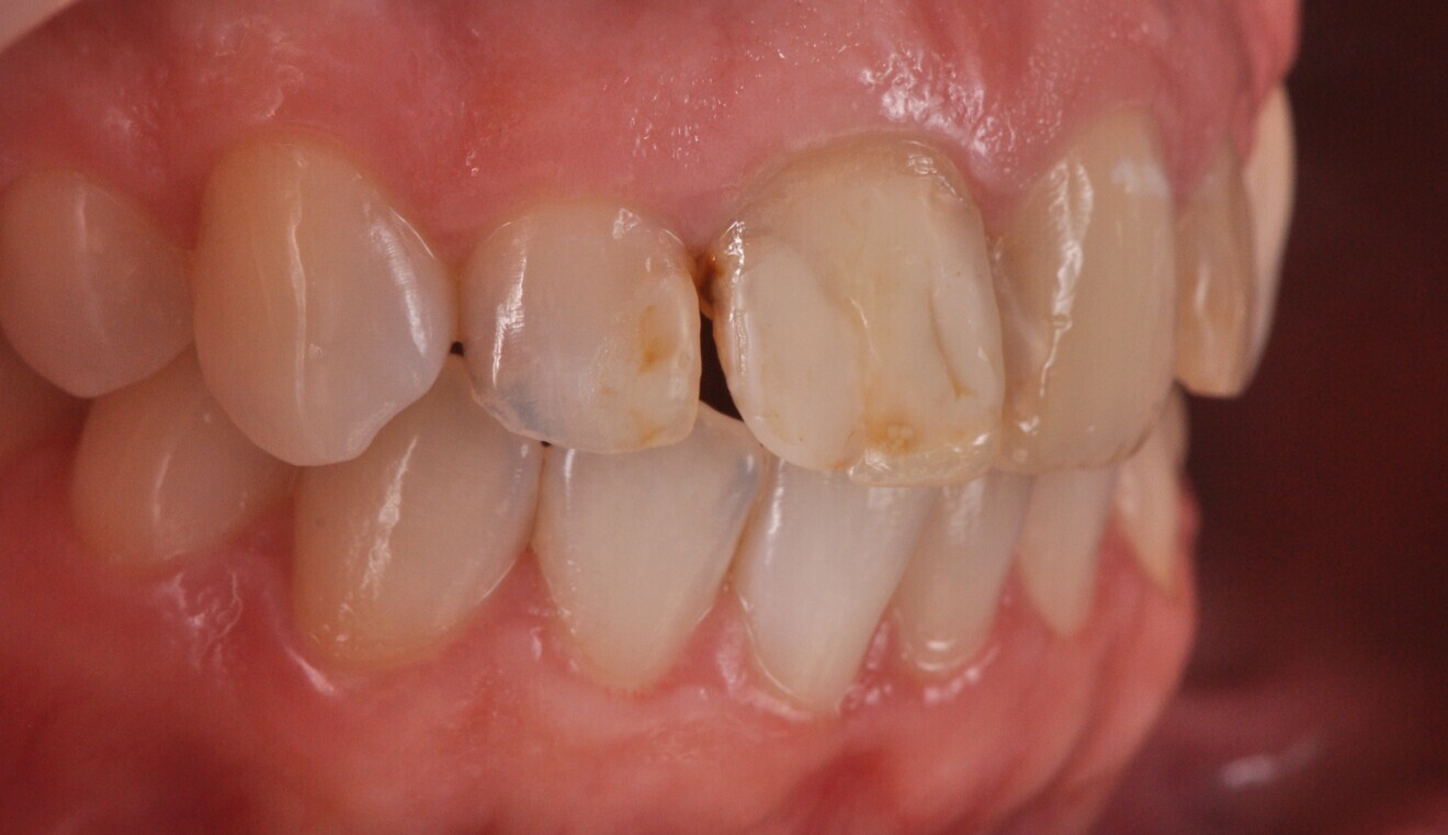 Fig. 3a: Restorations in need of replacement. Lateral view from the right.