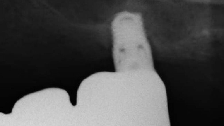 Restauro di un settore postero-superiore atrofico con impianti extracorti