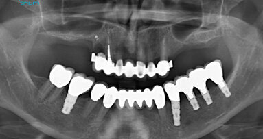 CBCT bone-densitometry for pre-surgical decision-making