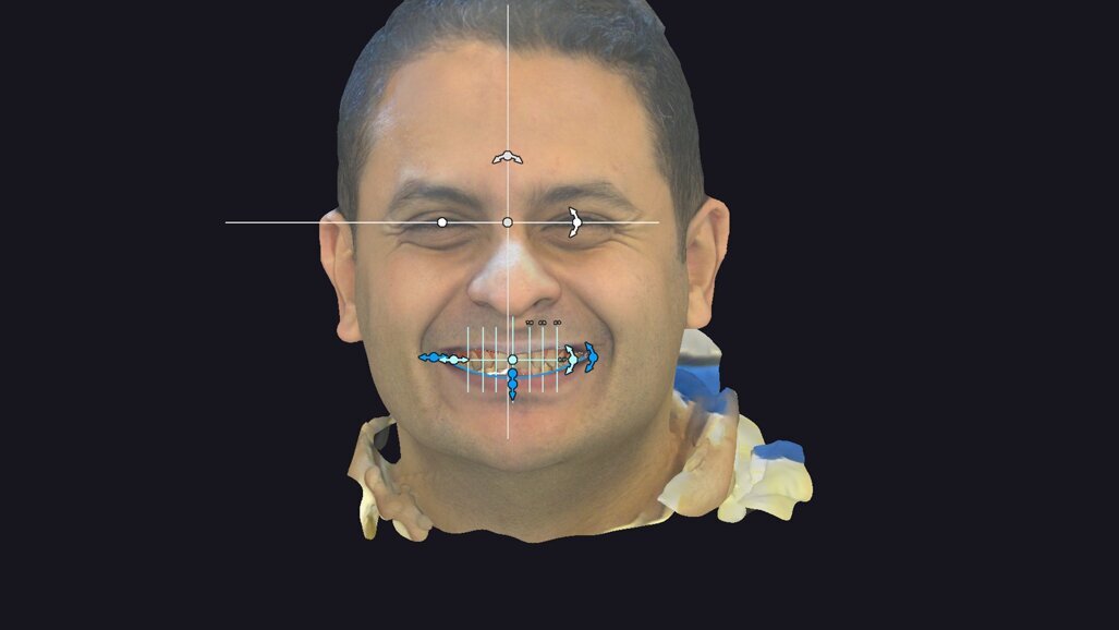 4D smile design case using exocad’s Smile Creator module and dynamic jaw motion