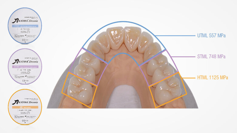 Full-mouth rehabilitation with three different types of KATANA Zirconia