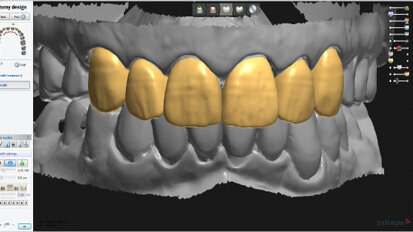 Smile analysis—Converting digital designs into the final smile Part II