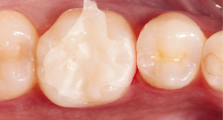 Fig. 4: Checking the fit and shade match of the inlay\ after the grinding process