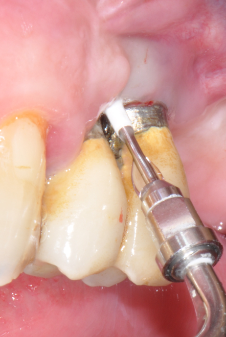 Fig.17: Case 2. Implant surface debridment with piezo-ceramic device and PEEK tip.