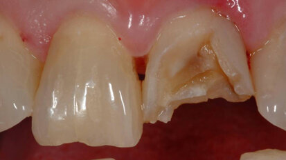 Many orofacial injuries during sports are preventable