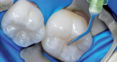 Kompobond: Vývoj nového dentálního výplňového materiálu – část II.