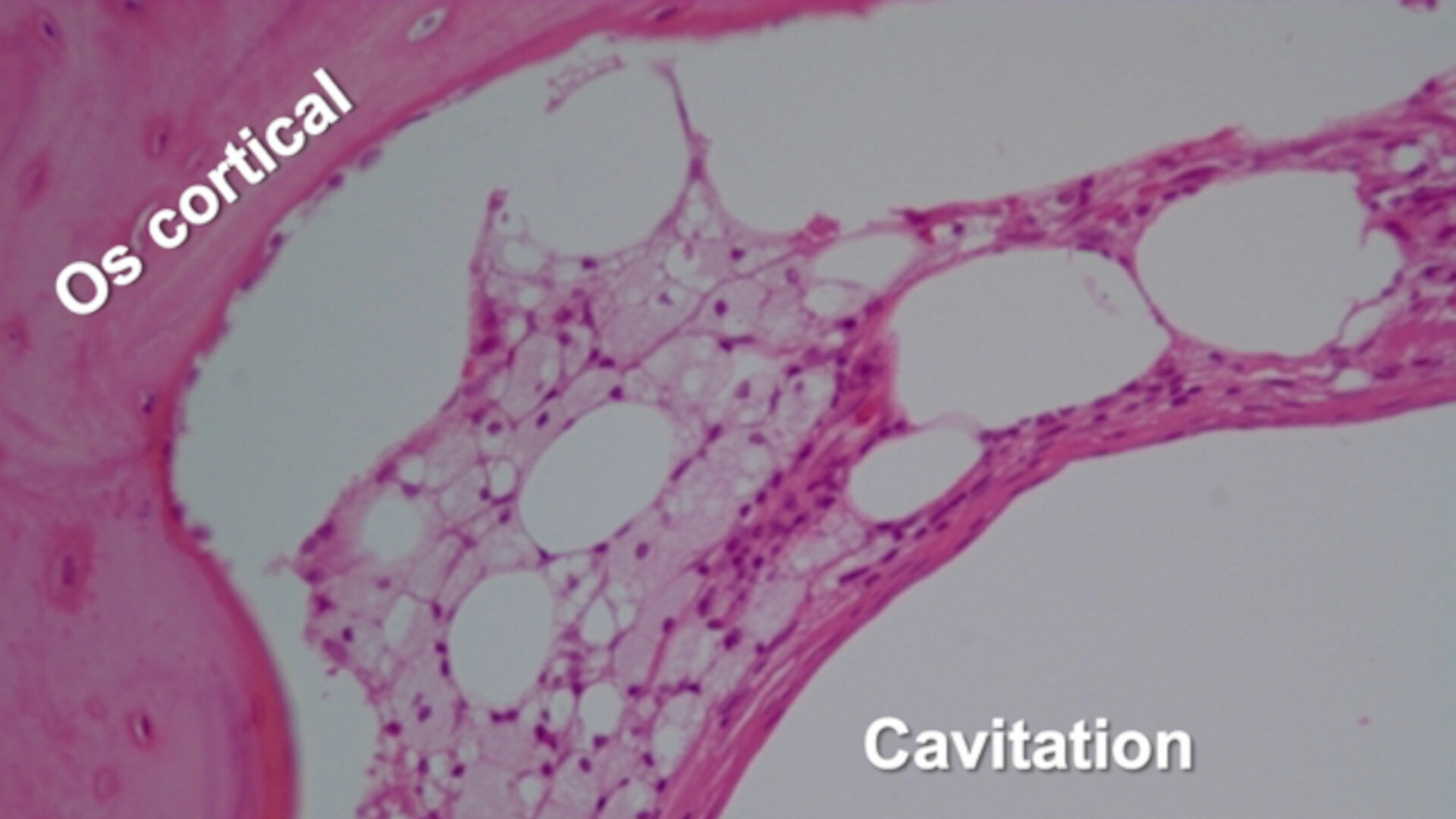 Échographie transalvéolaire dans le diagnostic des lésions inflammatoires de l’os