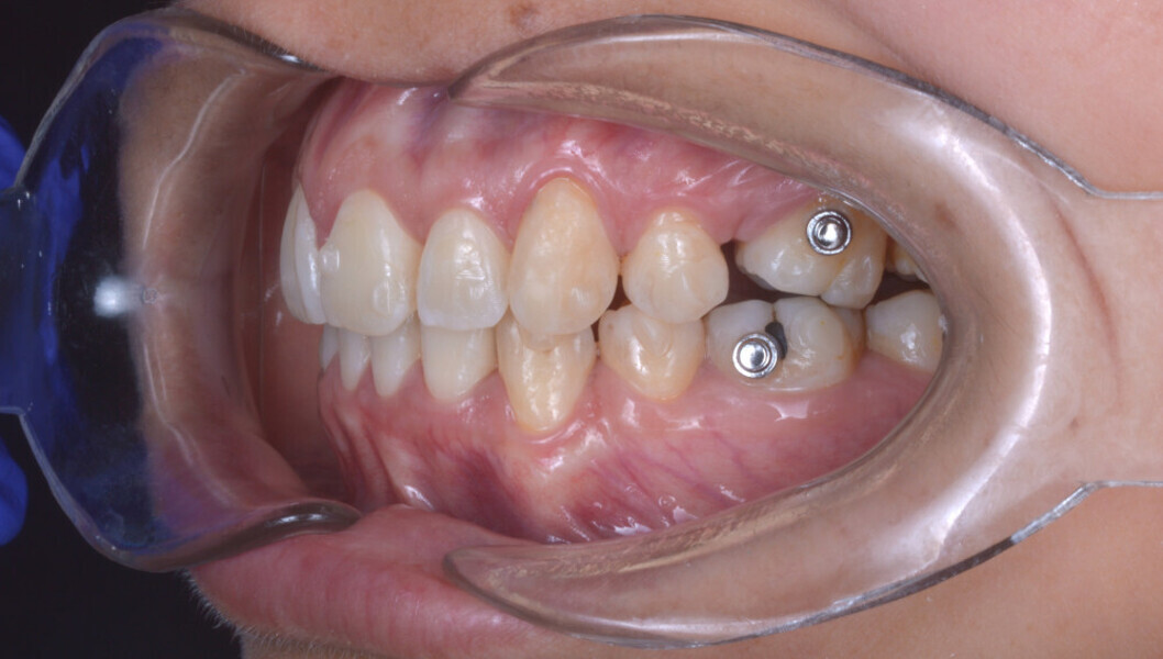 Fig. 6d: Intra-oral and occlusal photographs during treatment (after the 32nd aligner pair).