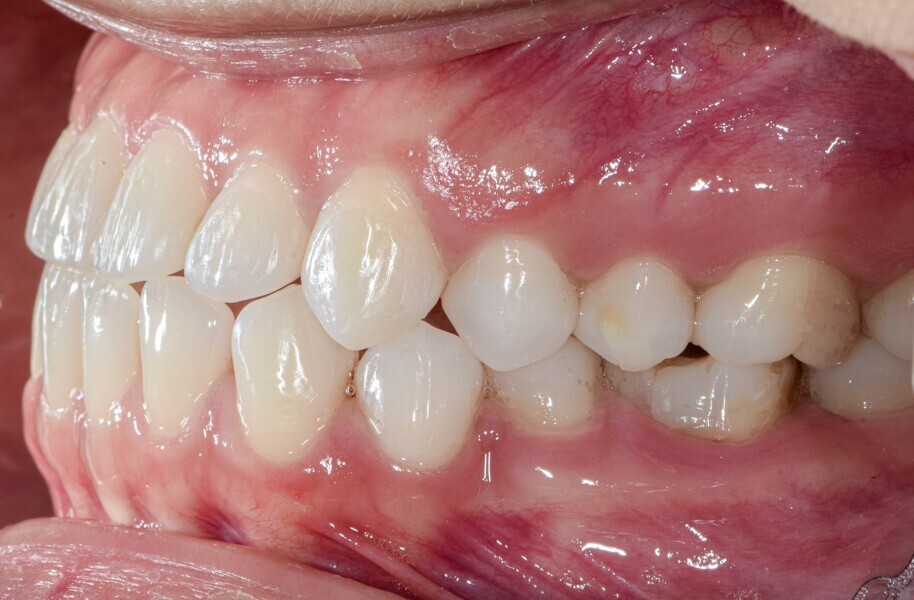 Fig. 12: Correction of the rotated premolar occurred in 12 weeks. Had the same tooth been rotated with just a composite attachment, it would have taken 38 weeks at the programmed 2° of rotation per aligner.