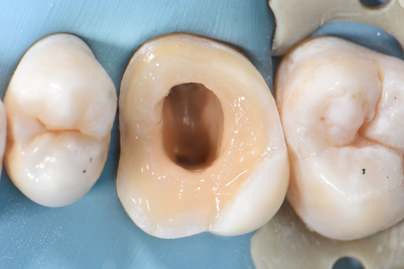 Fig. 11: Optimal cavity design after bonding of the composite base for the onlay, leaving only the access cavity open for the endodontist.