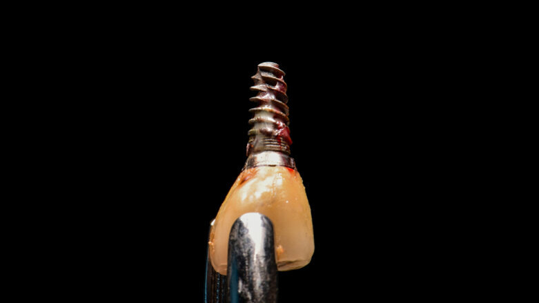 Réduire le risque de rejet des implants dentaires grâce aux biomatériaux