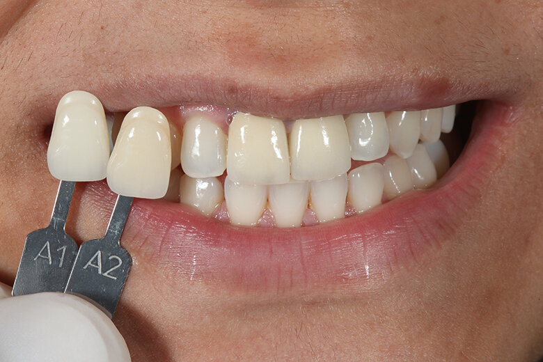 Fig. 2. El color dental básico A1 se determinó mediante la guía de colores VITA classical A1–D4.