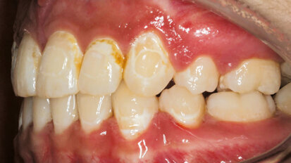 Dosáhneme hluboké remineralizace