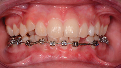 Il tailor-made del controllo del biofilm batterico. Nel paziente in trattamento ortodontico: case report