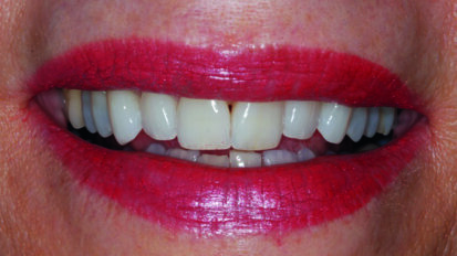 ΕΞΑΓΩΓΗ, ΑΜΕΣΗ ΤΟΠΟΘΕΤΗΣΗ ΕΜΦΥΤΕΥΜΑΤΟΣ ΚΑΙ ΑΜΕΣΗ ΤΟΠΟΘΕΤΗΣΗ ΜΗ ΛΕΙΤΟΥΡΓΙΚΗΣ ΠΡΟΣΩΡΙΝΗΣ ΑΠΟΚΑΤΑΣΤΑΣΗΣ ΑΚΟΛΟΥΘΩΝΤΑΣ ΜΙΑ ΠΛΗΡΩΣ ΨΗΦΙΑΚΗ ΡΟΗ ΕΡΓΑΣΙΩΝ