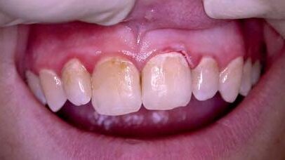 Leczenie parodontozy z większą mocą