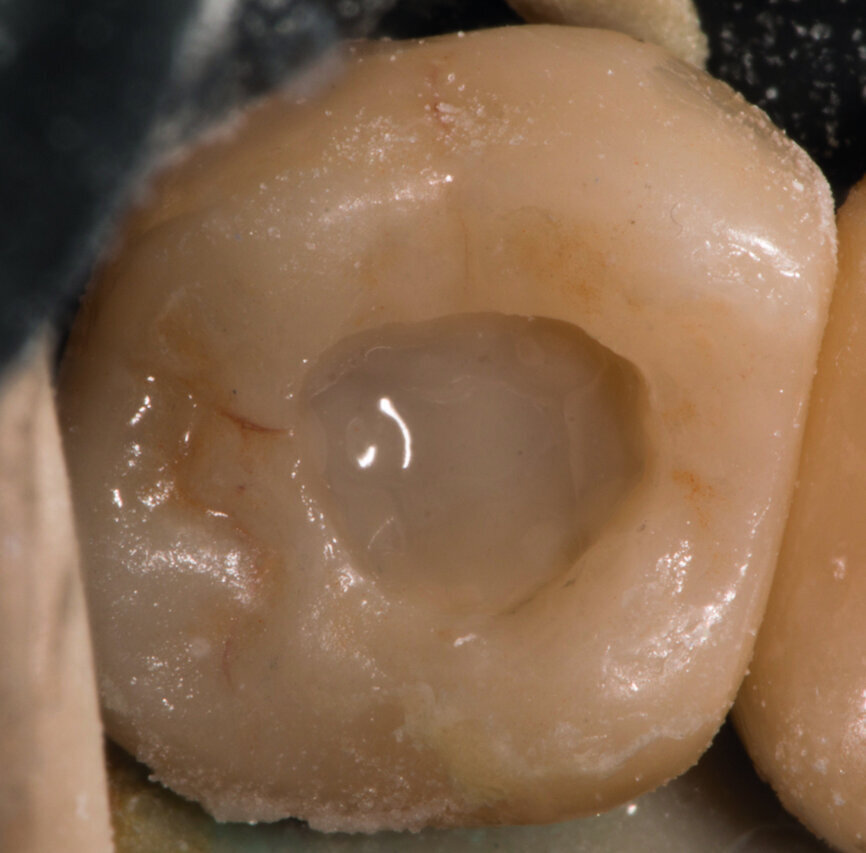 Fig. 14 : Essentia Masking Liner