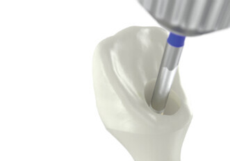 Nobel Biocare – angulated screw channel solutions